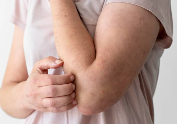 Homoeopathic treatment for eczema, psoriasis and skin diseases in Pune